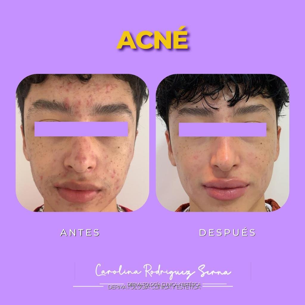 tratamiento cicatrices acne armenia